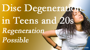 Pure Chiropractic relieves back pain due to disc degeneration in younger people in their teens and 20s. 