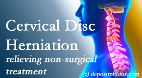 Pure Chiropractic offers the Cox® Technic spinal manipulation to treat cervical radiculopathy and avert surgery.